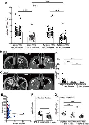 High CT Attenuation Values Relative to the Brainstem Predict Fungal Hyphae Within the Sinus